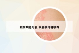 銀屑病能母乳 銀屑病母乳喂養(yǎng)