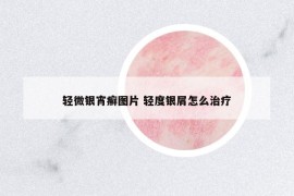 輕微銀宵癬圖片 輕度銀屑怎么治療