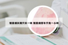 銀屑病長(zhǎng)期只長(zhǎng)一塊 銀屑病常年只有一小塊