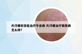 片仔癀軟膏能治療牛皮癬 片仔癀治療銀屑病怎么樣?