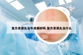 復(fù)方青黛丸治牛皮癬好嗎 復(fù)方青黛丸治什么