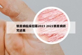 銀屑病臨床招募2023 2021銀屑病研究進展