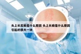 頭上長(zhǎng)出癬是什么原因 頭上長(zhǎng)癬是什么原因引起的很大一塊