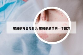 銀屑病克星是什么 銀屑病最怕的一個(gè)偏方