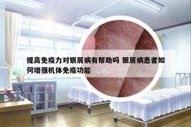 提高免疫力對(duì)銀屑病有幫助嗎 銀屑病患者如何增強(qiáng)機(jī)體免疫功能