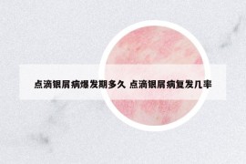 點(diǎn)滴銀屑病爆發(fā)期多久 點(diǎn)滴銀屑病復(fù)發(fā)幾率