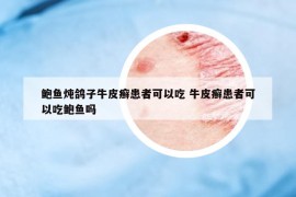 鮑魚燉鴿子牛皮癬患者可以吃 牛皮癬患者可以吃鮑魚嗎