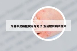 煙臺(tái)牛皮癬醫(yī)院治療方法 煙臺(tái)銀屑病研究所
