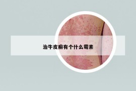 治牛皮癬有個什么霉素