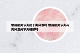 銀屑病關(guān)節(jié)炎屬于類(lèi)風(fēng)濕嗎 銀屑病關(guān)節(jié)炎與類(lèi)風(fēng)濕關(guān)節(jié)炎相似嗎