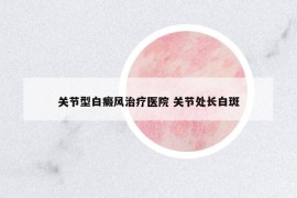 關(guān)節(jié)型白癜風(fēng)治療醫(yī)院 關(guān)節(jié)處長(zhǎng)白斑
