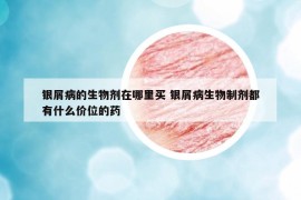 銀屑病的生物劑在哪里買 銀屑病生物制劑都有什么價位的藥