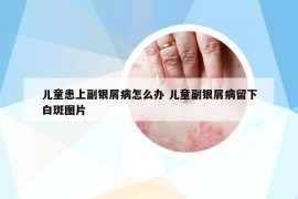 兒童患上副銀屑病怎么辦 兒童副銀屑病留下白斑圖片