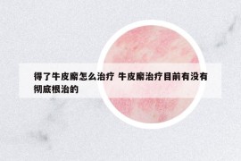 得了牛皮廨怎么治療 牛皮廨治療目前有沒有徹底根治的