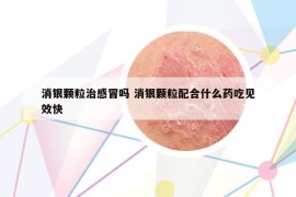 消銀顆粒治感冒嗎 消銀顆粒配合什么藥吃見效快