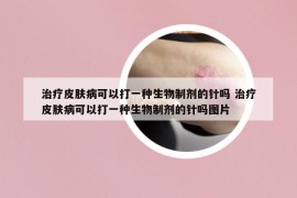 治療皮膚病可以打一種生物制劑的針嗎 治療皮膚病可以打一種生物制劑的針嗎圖片