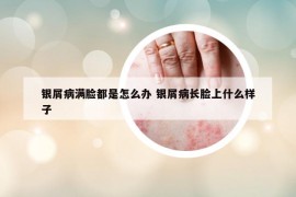 銀屑病滿臉都是怎么辦 銀屑病長(zhǎng)臉上什么樣子
