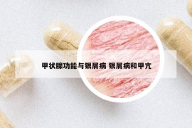 甲狀腺功能與銀屑病 銀屑病和甲亢