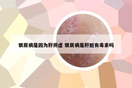 銀屑病是因?yàn)楦侮幪?銀屑病是肝臟有毒素嗎
