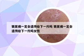 銀屑病一定會(huì)遺傳給下一代嗎 銀屑病一定會(huì)遺傳給下一代嗎女性