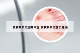 皮膚長白斑圖片大全 皮膚長白斑什么原因