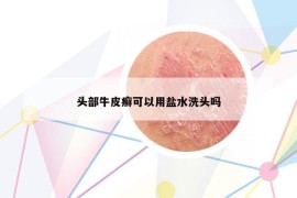 頭部牛皮癬可以用鹽水洗頭嗎