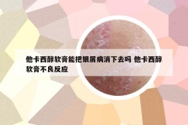 他卡西醇軟膏能把銀屑病消下去嗎 他卡西醇軟膏不良反應