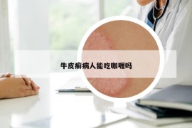 牛皮癬病人能吃咖喱嗎