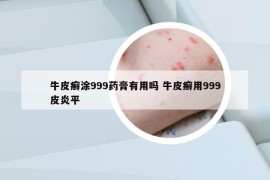 牛皮癬涂999藥膏有用嗎 牛皮癬用999皮炎平