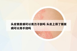頭皮銀屑病可以用刀子刮嗎 頭皮上得了銀屑病可以用手撓嗎