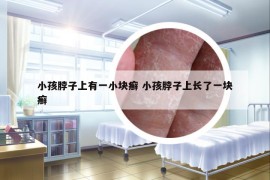 小孩脖子上有一小塊癬 小孩脖子上長了一塊癬