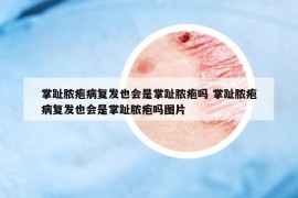 掌趾膿皰病復(fù)發(fā)也會是掌趾膿皰嗎 掌趾膿皰病復(fù)發(fā)也會是掌趾膿皰嗎圖片