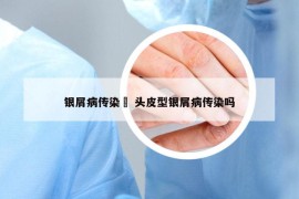 銀屑病傳染嗎 頭皮型銀屑病傳染嗎