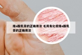 維a酸乳膏的正確用法 毛周角化癥維a酸乳膏的正確用法
