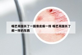 嘴巴周圍長(zhǎng)了一圈像皮癬一樣 嘴巴周圍長(zhǎng)了癬一樣的東西