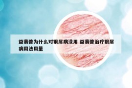 益賽普為什么對銀屑病沒用 益賽普治療銀屑病用法用量