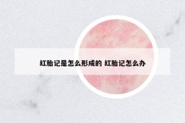 紅胎記是怎么形成的 紅胎記怎么辦