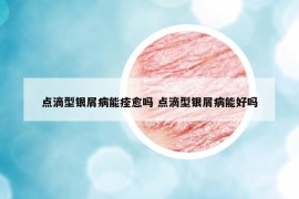 點滴型銀屑病能痊愈嗎 點滴型銀屑病能好嗎
