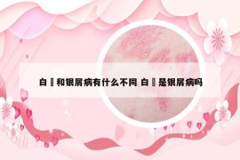 白疕和銀屑病有什么不同 白疕是銀屑病嗎