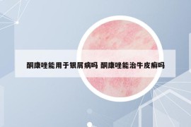 酮康唑能用于銀屑病嗎 酮康唑能治牛皮癬嗎