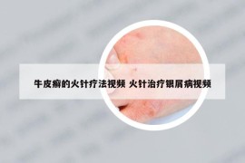 牛皮癬的火針療法視頻 火針治療銀屑病視頻