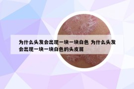 為什么頭發(fā)會出現(xiàn)一塊一塊白色 為什么頭發(fā)會出現(xiàn)一塊一塊白色的頭皮屑