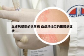 血虛風(fēng)燥型的銀屑病 血虛風(fēng)燥型的銀屑病癥狀