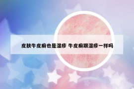 皮膚牛皮癬也是濕疹 牛皮癬跟濕疹一樣嗎