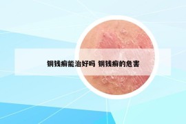 銅錢癬能治好嗎 銅錢癬的危害