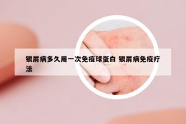 銀屑病多久用一次免疫球蛋白 銀屑病免疫療法