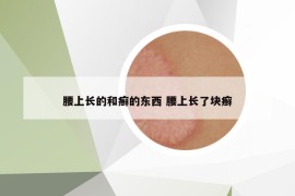 腰上長的和癬的東西 腰上長了塊癬