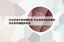 什么藥治牛皮效果好點 什么藥治牛皮效果好點北京仲博醫(yī)院電話