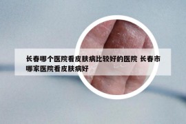 長(zhǎng)春哪個(gè)醫(yī)院看皮膚病比較好的醫(yī)院 長(zhǎng)春市哪家醫(yī)院看皮膚病好