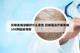 抗銀屑病涂膜擠什么意思 抗銀霜治療銀屑病156例臨床觀察